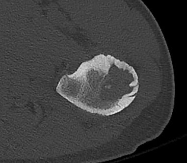 Osteoblastoma | The Bone School